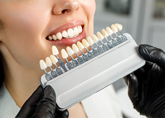 Was-sind-Veneers-und-wie-können-sie-Ihre-Zähne-verbessern